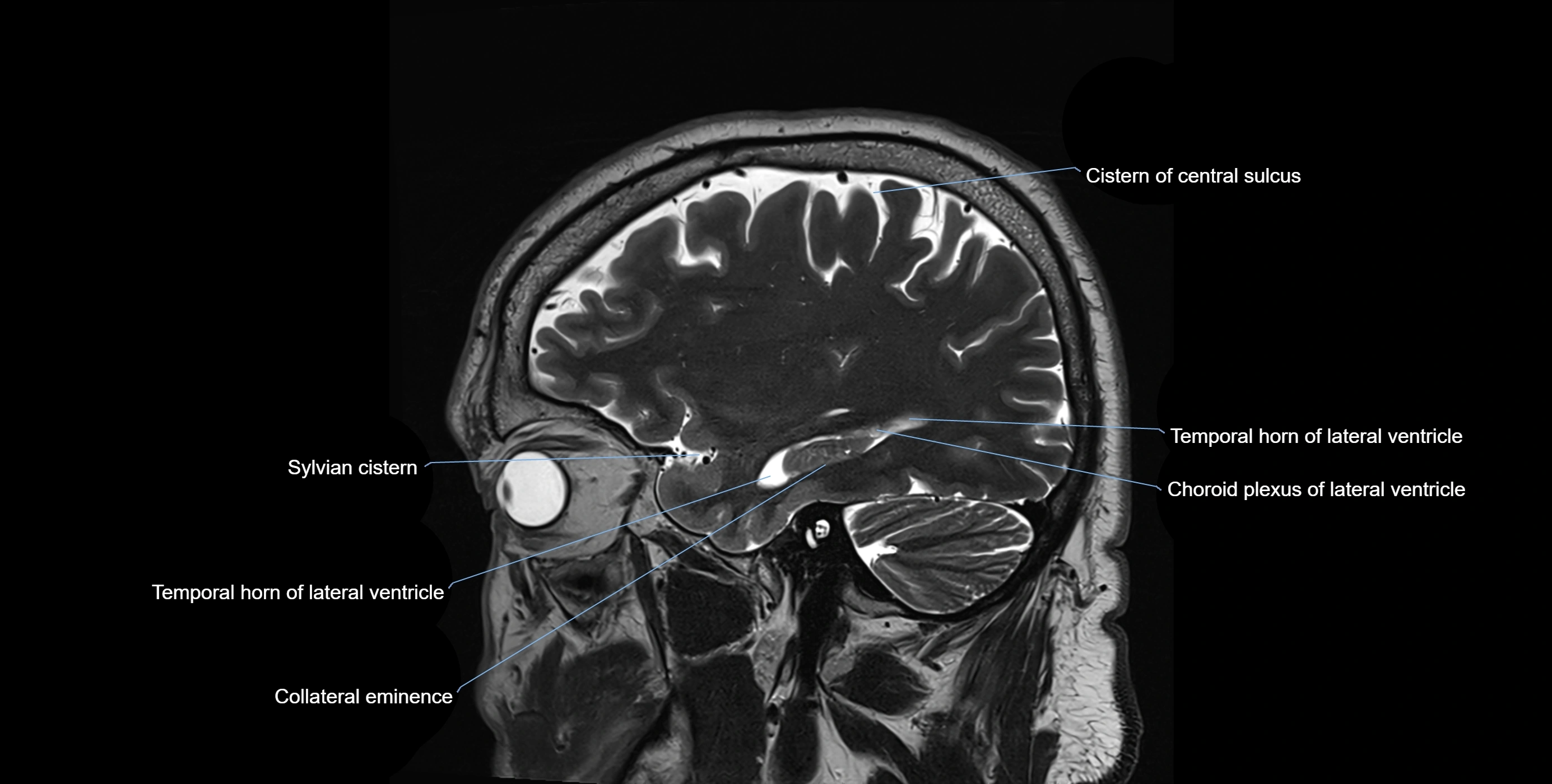 Brain cisterns  and ventricles sagittal anatomy 3T MRI image-img-00001-00014.webp